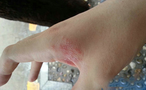 慢性湿疹是怎么引起的_慢性湿疹用什么药膏最