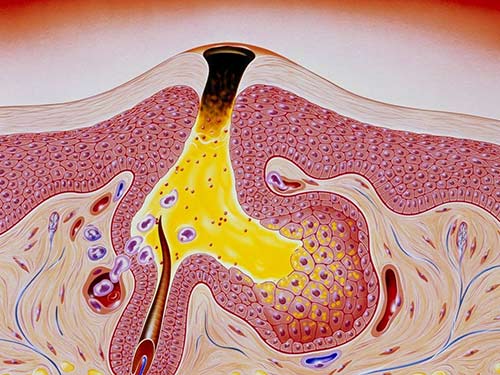 黑头粉刺是怎么形成的