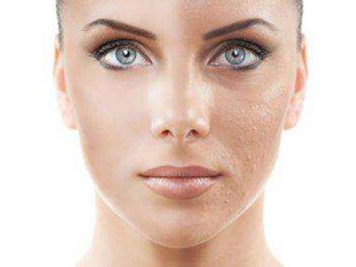 黑头粉刺是怎么形成的