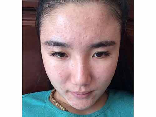 闭口粉刺怎么办