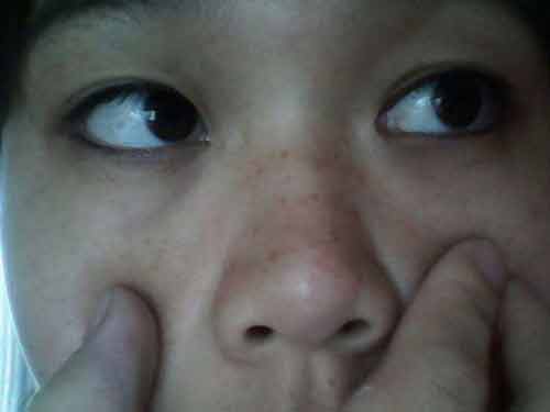 黑头毛孔粗大怎么办呢