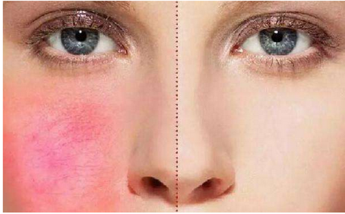 夏天脸上痒怎么办