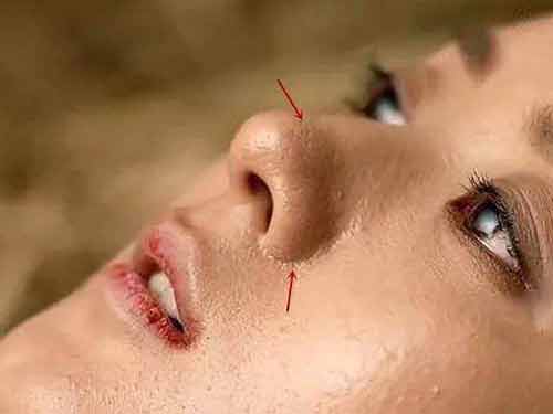 脸上长黑头怎么去除