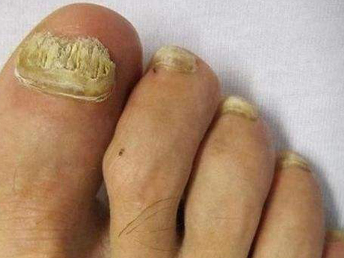 脚趾甲变厚怎么回事