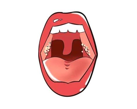 扁桃体发炎化脓怎么办