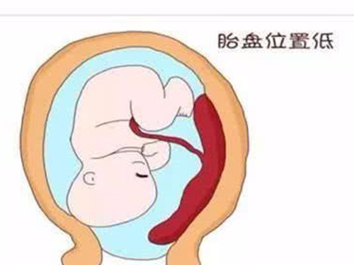 胎盘低是怎么回事