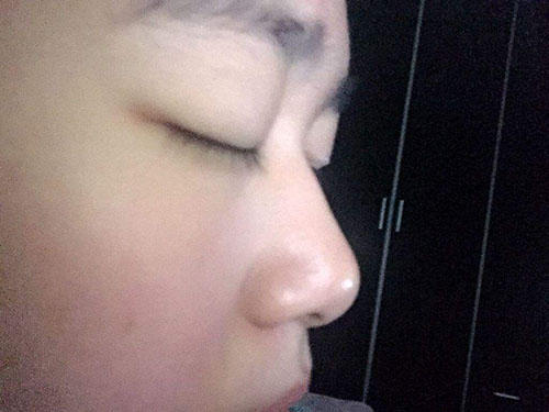 塌鼻梁怎么办