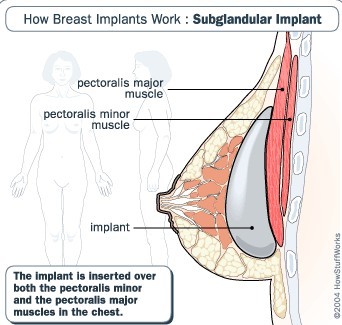 注射丰胸的危害,女人必看-圣荷(STHERB)
