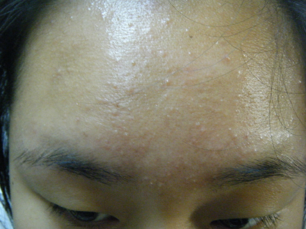 脸上长粉刺怎么办 教你轻松击溃封闭性粉刺