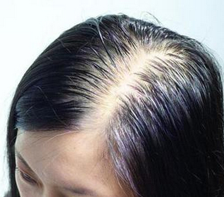 三种导致头发油腻脱发的解决方法