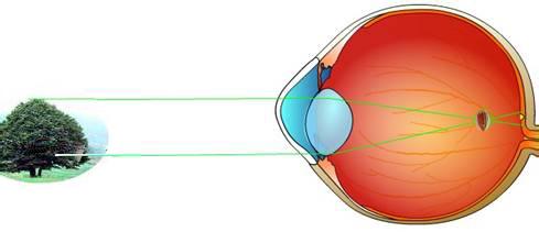 近视度数加深的原因,你清楚了吗?-近视眼(nea