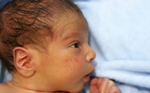 怎么婴儿是否湿疹 教你如何辨别湿疹-湿疹(ecz