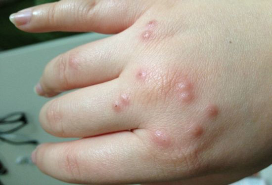 丘疹性荨麻疹能自愈吗图片