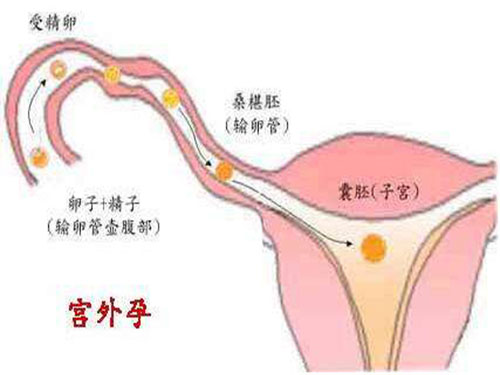 宫外孕是怎么回事宫外孕症状 宫外孕是怎么回事宫外孕症状