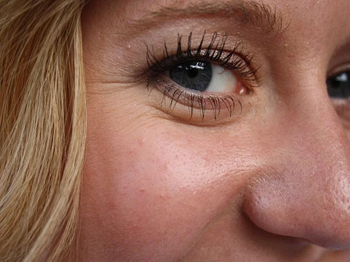 眼睑皱纹深是什么情况眼睑皱纹能用玻尿酸吗