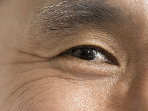 男人的鱼尾纹怎么去除比较有效?